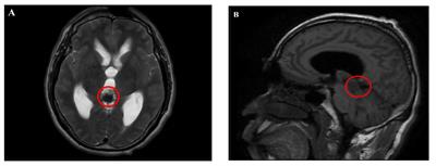 Solitary fibrous tumor of the pineal gland: a case report and review of the literature